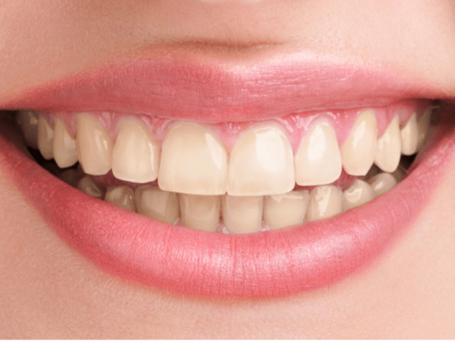 https://makeoverdentalstudio.com.mx/wp-content/uploads/2021/06/captura-de-pantalla-2020-09-08-a-las-18.27.28-640x480.png