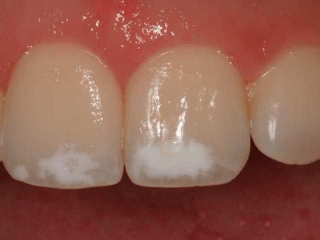 https://makeoverdentalstudio.com.mx/wp-content/uploads/2021/06/captura-de-pantalla-2021-04-16-a-las-0.05.47-640x480.png