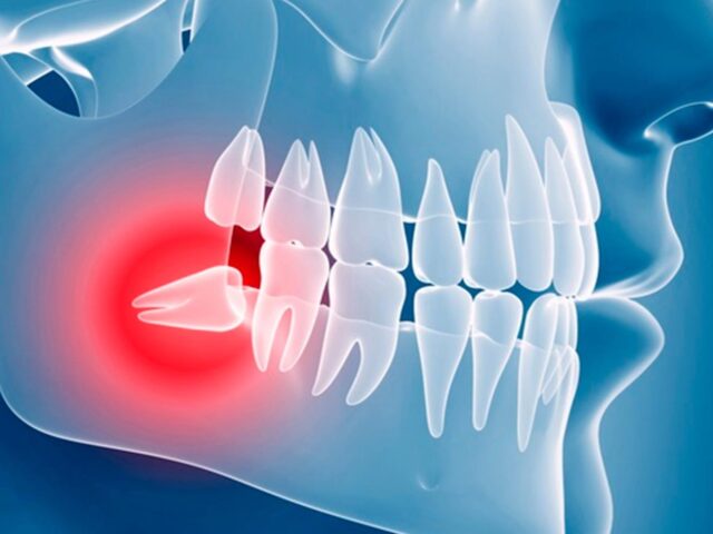 https://makeoverdentalstudio.com.mx/wp-content/uploads/2021/06/clinica-internacional-odontologia-muela-juicio-portada-640x480.jpg