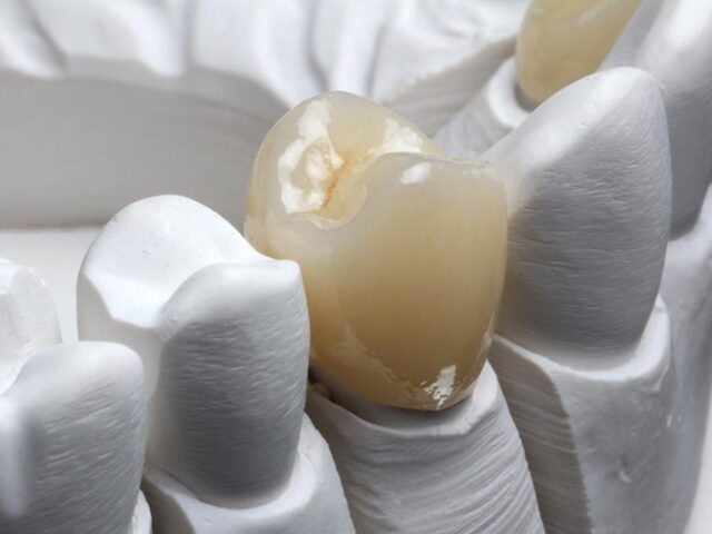 https://makeoverdentalstudio.com.mx/wp-content/uploads/2021/06/crown2-640x480.jpg