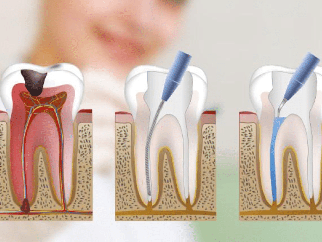 https://makeoverdentalstudio.com.mx/wp-content/uploads/2021/06/endodoncia-640x480.png