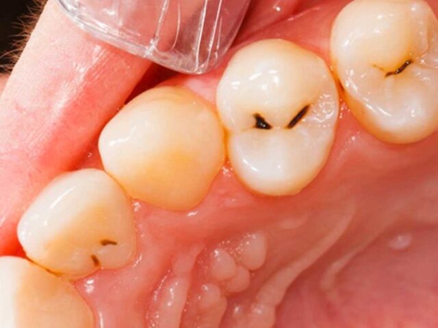 https://makeoverdentalstudio.com.mx/wp-content/uploads/2021/06/image-6-640x480.jpeg