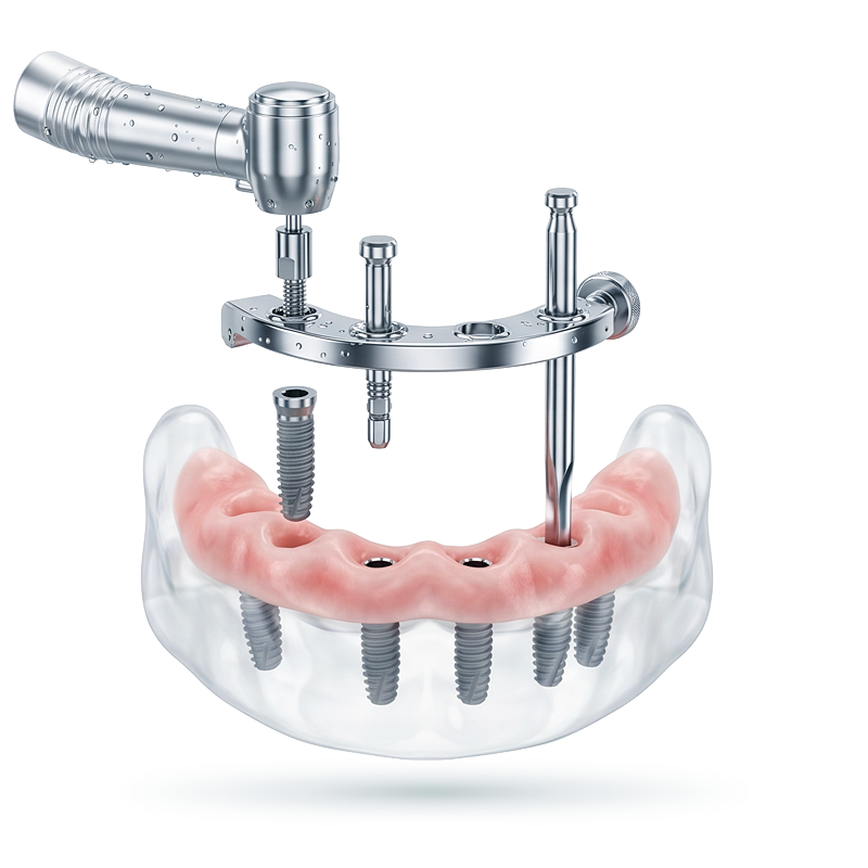 Render of a surgical guide over an implant model