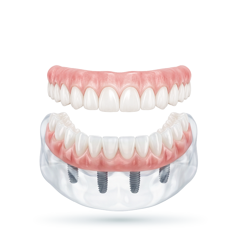 Render of full upper and lower dentures over implants