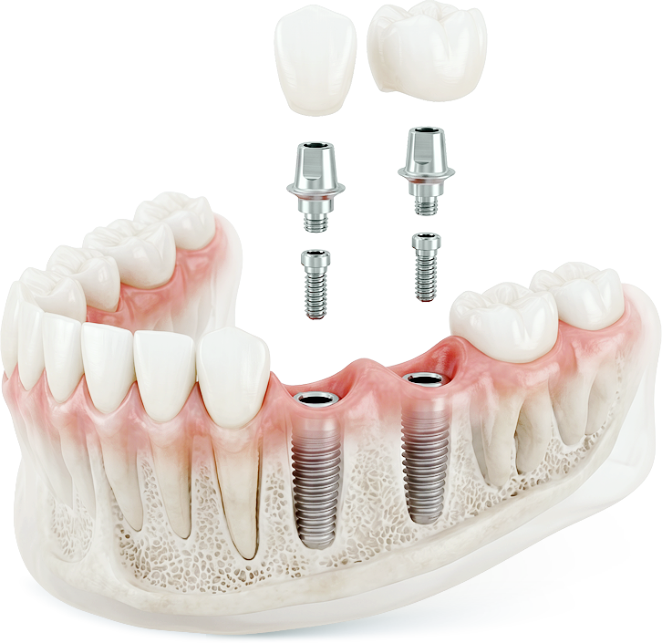 Render of a jaw model with two implants and separate crowns