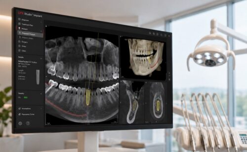 Screenshot of Nobel Biocare DTX Studio Implant software