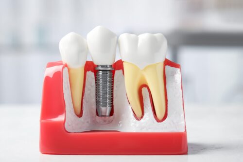 Red cross-section model with an implant between two teeth