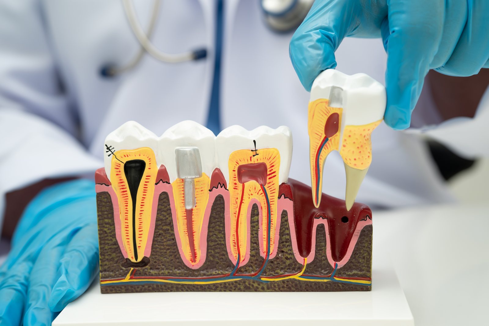 Dental model showing tooth anatomy with implant, Tijuana