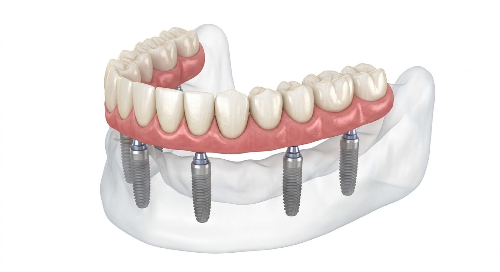 Illustration: lower arch prosthesis supported by 6 vertical implants spaced evenly along the jaw