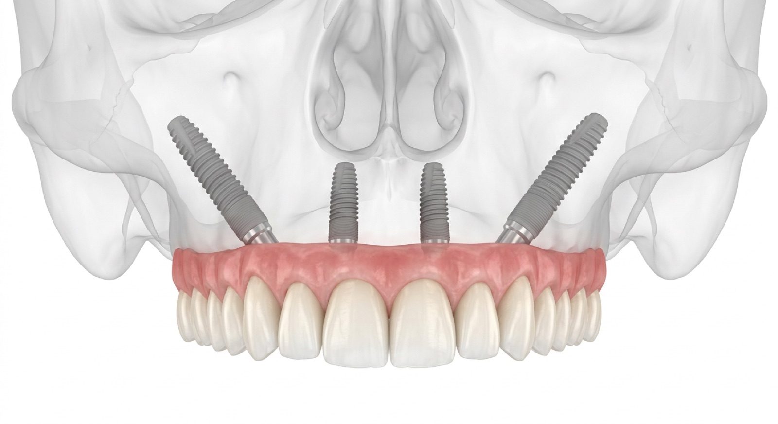Illustration: frontal view of an upper jaw with implants placed at varied angles beneath a full arch