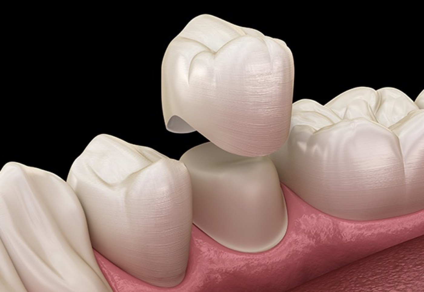 Implant treatment at Makeover Dental Studio in Tijuana