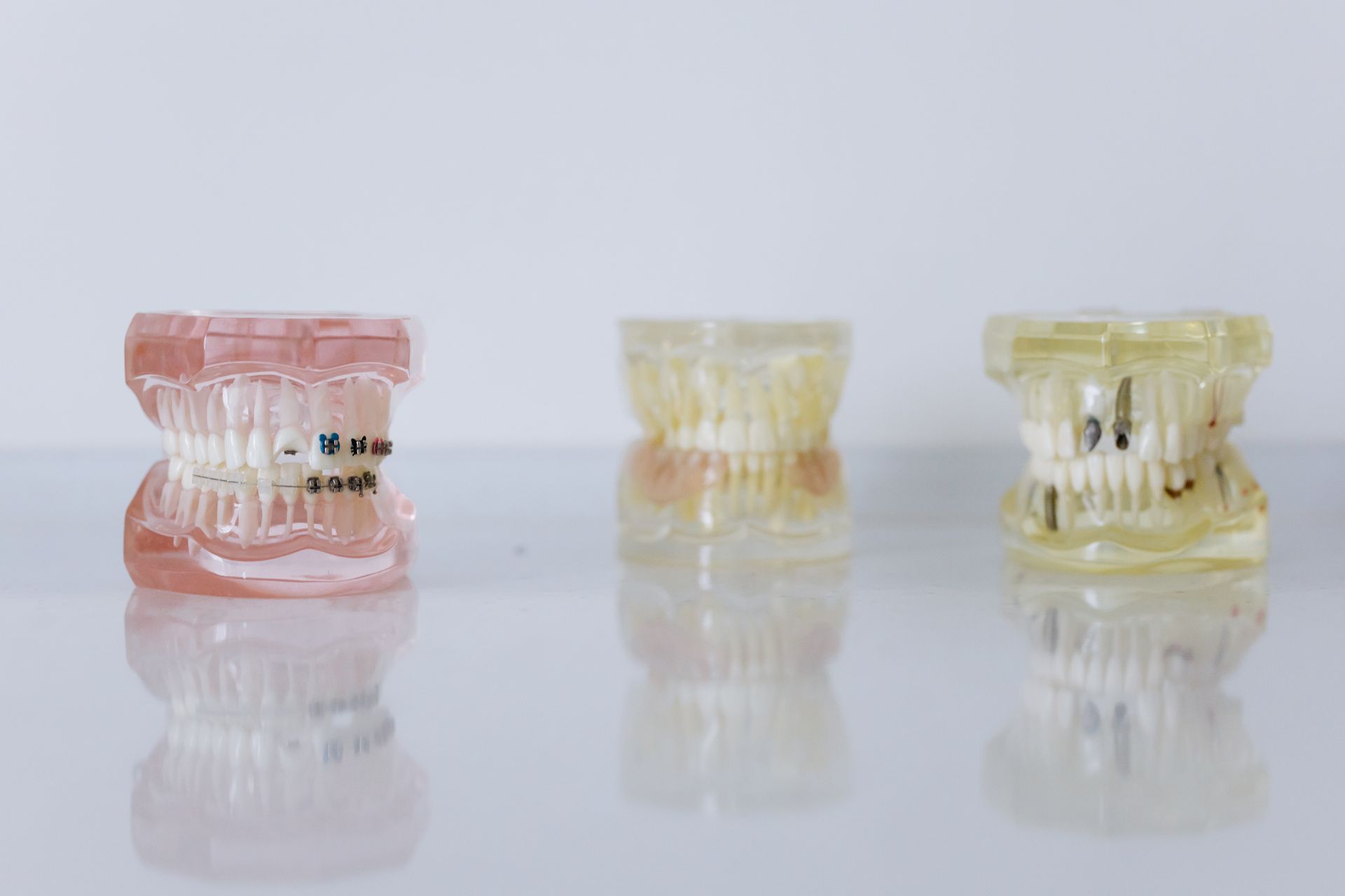 Three dental arch models in a row, the left one with braces