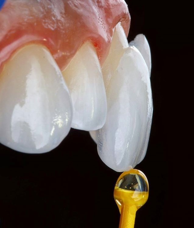 Porcelain veneer being seated with bonding cement over the upper front teeth at Makeover Dental Studio in Tijuana
