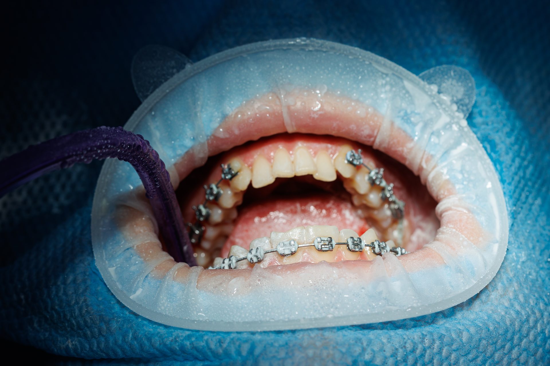 Top view of a dental cleaning with a lip retractor